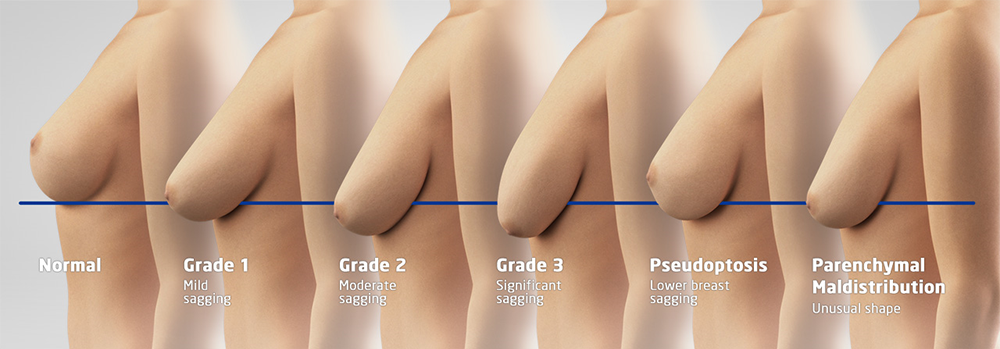 Esquema de los grados de ptosis mamaria según la posición del pezón respecto al surco inframamario.