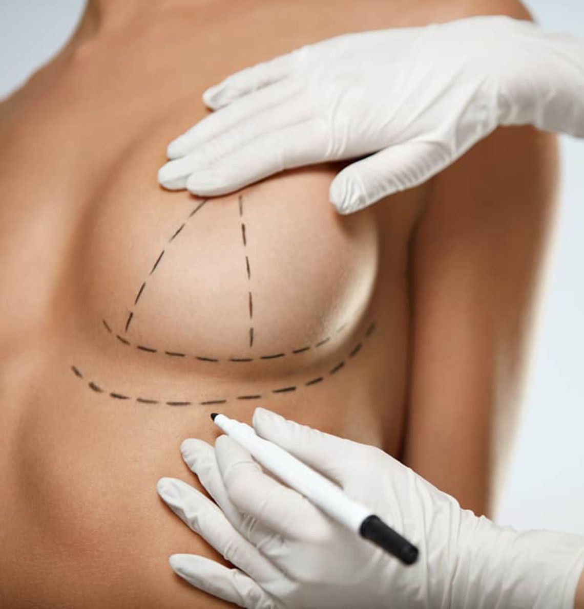 Mastopexia con el Dr Rodrigo Montoya en Medellín