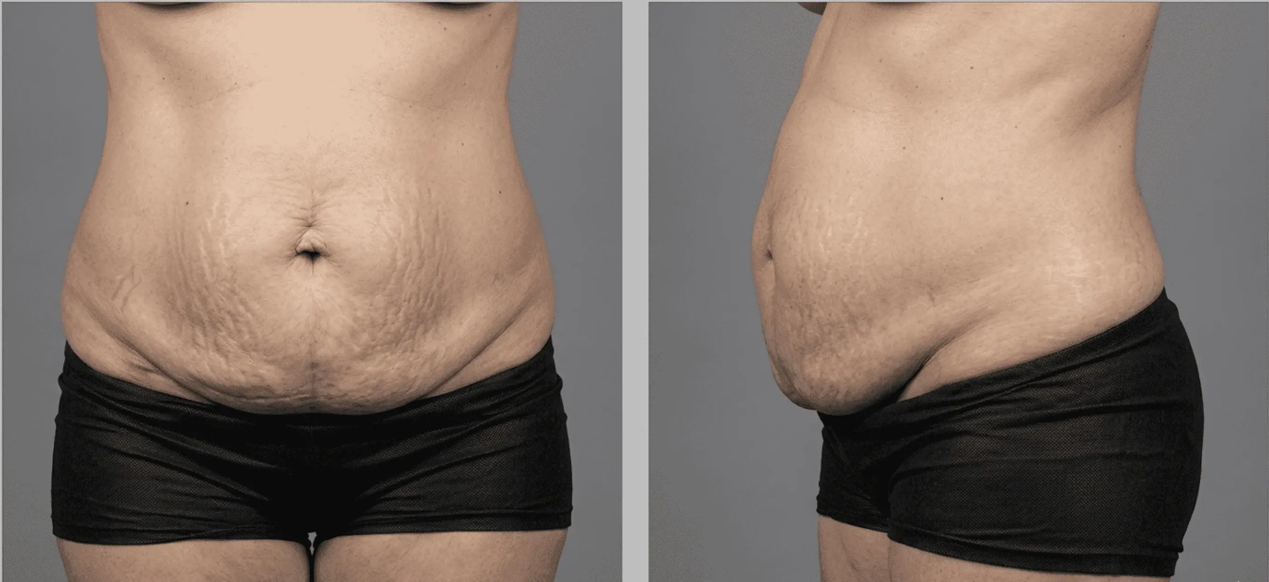 Abdomen de frente y de lado antes de Abdominoplastia con el Dr Rodrigo Montoya