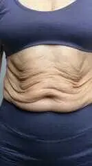 abdomen antes de una abdominoplastia con el Dr Rodrigo Montoya en Medellín