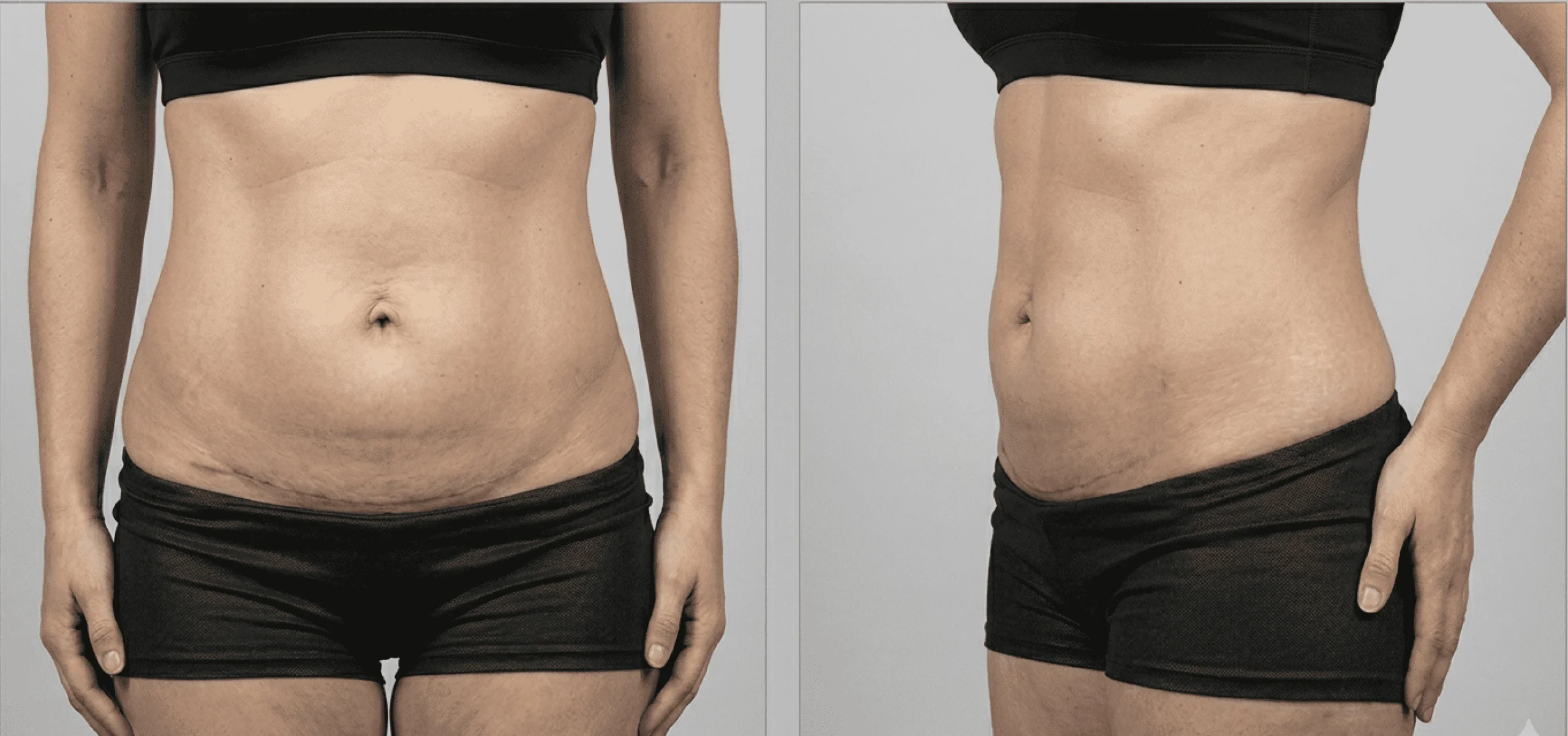 Abdomen de mujer después de una abdominoplastia con el Dr. Rodrigo Montoya en Medellín
