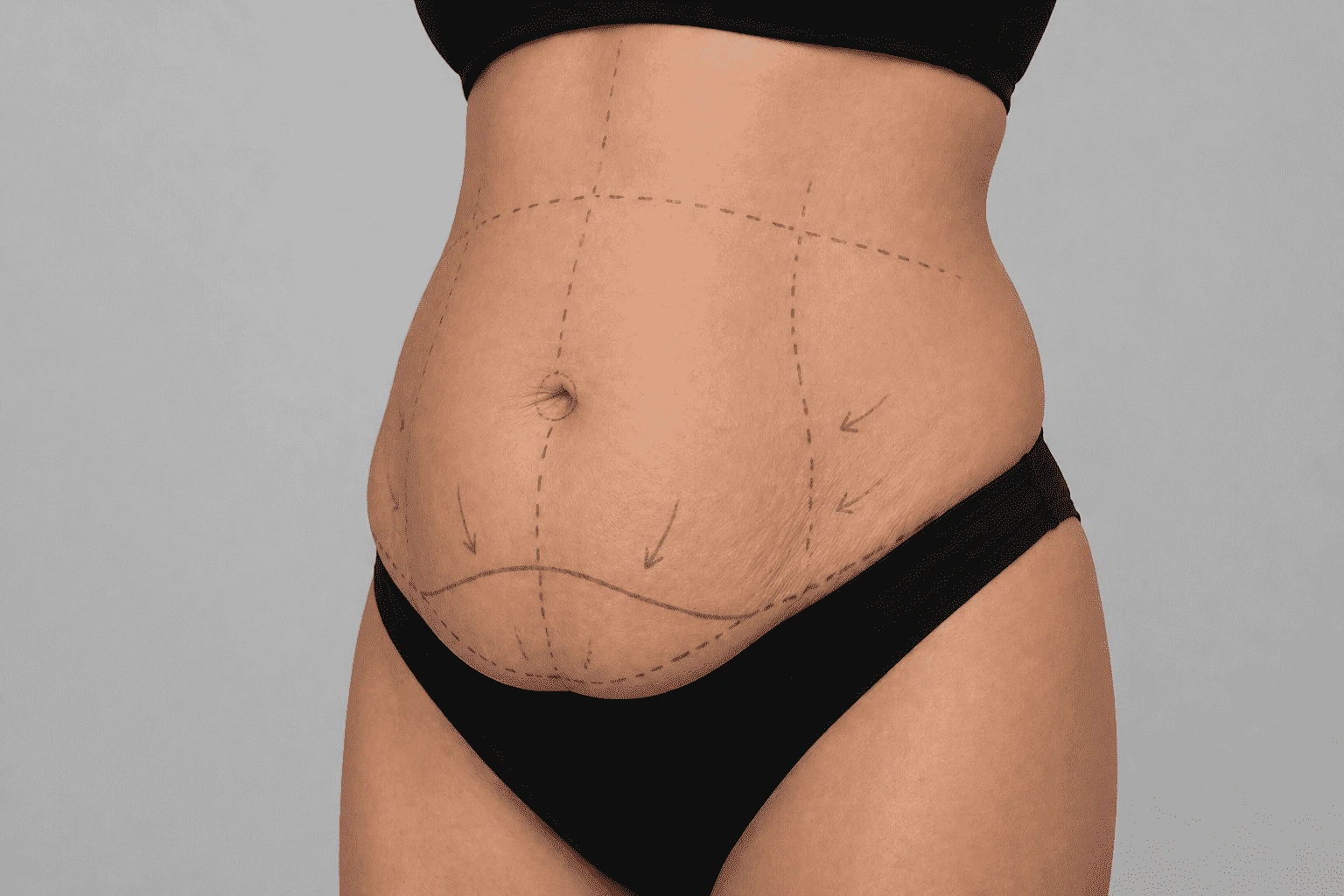 Abdomen de lado y marcado para abdominoplastia con el Dr. Rodrigo Montoya en Medellín