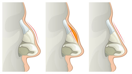 Ilustración de perfil nasal antes y después de una rinoplastia