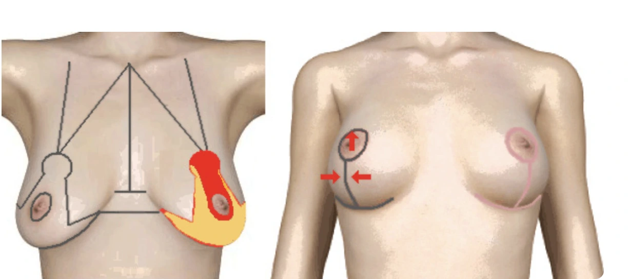Remodelación glandular durante una mastopexia (lifting de senos): reconstrucción del cono mamario.