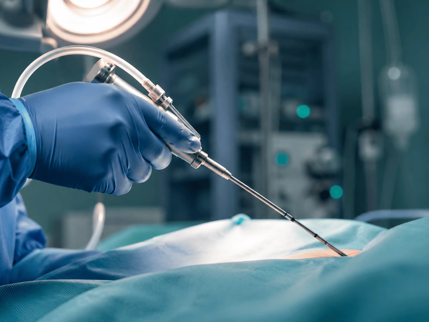 Aspiración con cánula en lipoescultura por el Dr. Rodrigo Montoya, cirugía plástica en Medellín