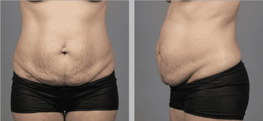 Abdomen de una paciente antes de una abdominoplastia con el Dr. Rodrigo Montoya, vista de frente y de perfil